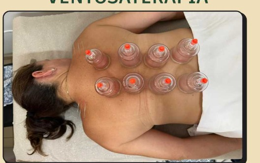 Ventosaterapia